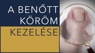 Benőtt köröm kezelése a gyakorlatban - borítókép