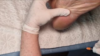 Bemutató kezelés, 3. modell, talpvizsgálat